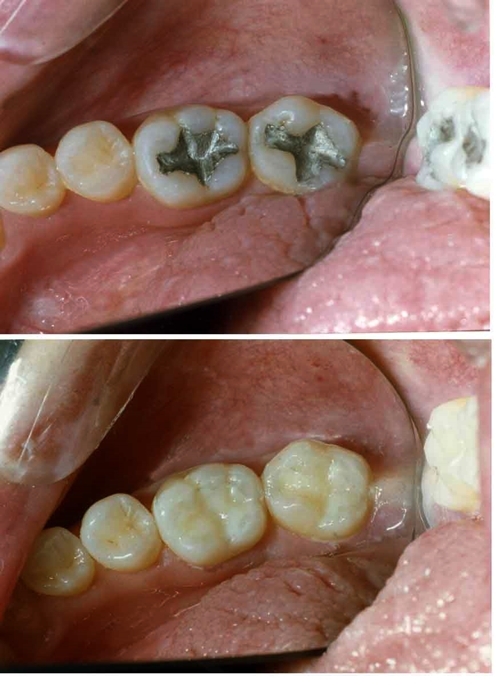 Mẹo lợi hại giúp răng mọc lại mà không cần hàn răng hay trồng răng giả